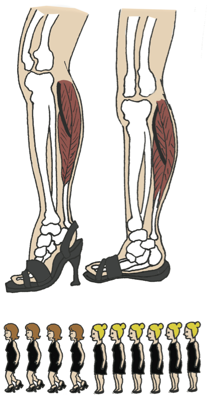 The bones in the foot are restricted in the heel, which causes the center of balance to shift forward and up. This can cause knee complications along with discomfort in the arch of the foot.