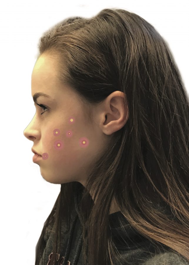 Acne, a chronic inflammatory skin condition, is characterized by blackheads, whiteheads, pimples and deeper lumps that occur on the face, neck, chest, back, shoulders and upper arms.